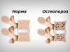 Остеопороз и причины его возникновения. Диагностика. Лечение. Профилактика